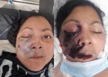 El primer caso de Hongo Negro en Venezuela