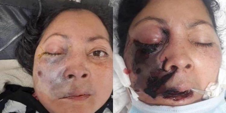 El primer caso de Hongo Negro en Venezuela