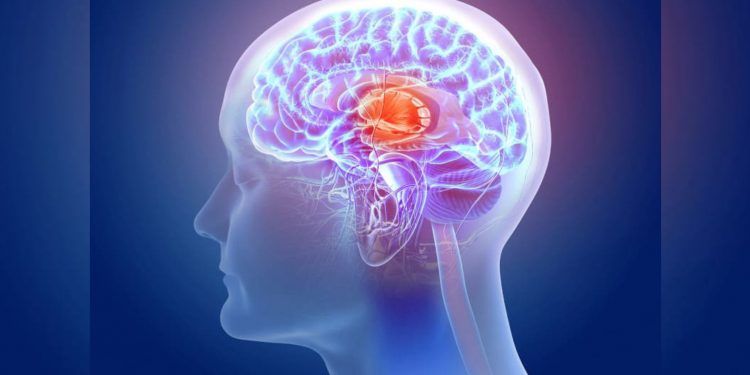 ¿Cuáles son los síntomas de un derrame cerebral? Reconózcalos para que pueda tratarlo a tiempo