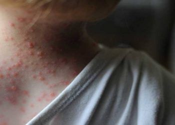 Portugal: Descubren 5 casos de viruela del mono en hombres