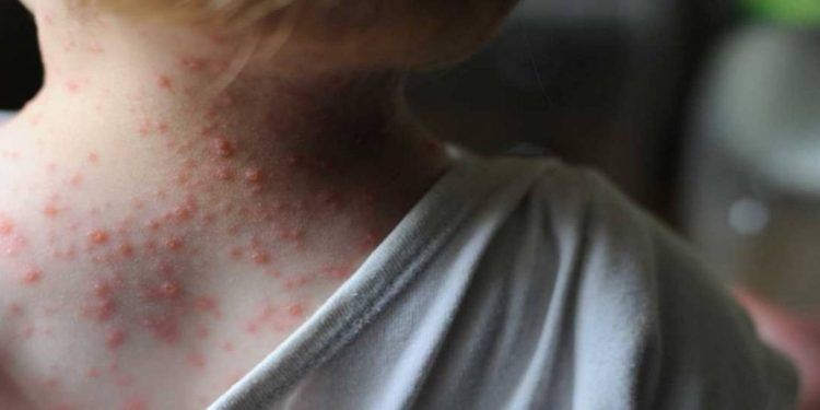 Portugal: Descubren 5 casos de viruela del mono en hombres