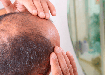 Primera píldora para el tratamiento de la alopecia fue aprobada en Estados Unidos