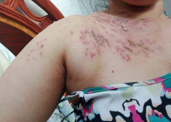 Venezuela: Alertan sobre posible epidemia del Herpes Zóster «culebrilla» en varias regiones del país