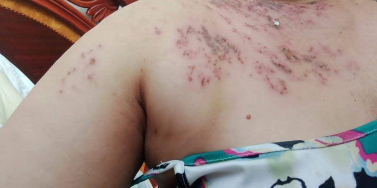 Venezuela: Alertan sobre posible epidemia del Herpes Zóster «culebrilla» en varias regiones del país