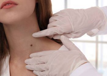 Melanoma, cuando el exceso de sol se convierte en una peligrosa enfermedad