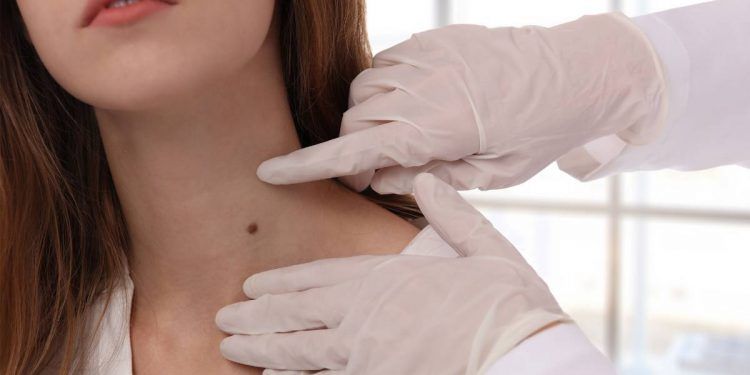 Melanoma, cuando el exceso de sol se convierte en una peligrosa enfermedad