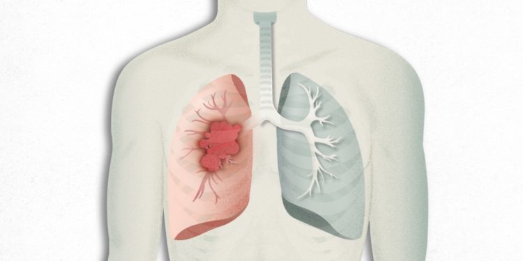 Cáncer de pulmón