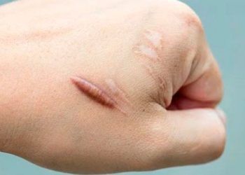 ¿Qué es una cicatriz queloide? Entérate cuáles son sus causas y si es posible prevenirlas