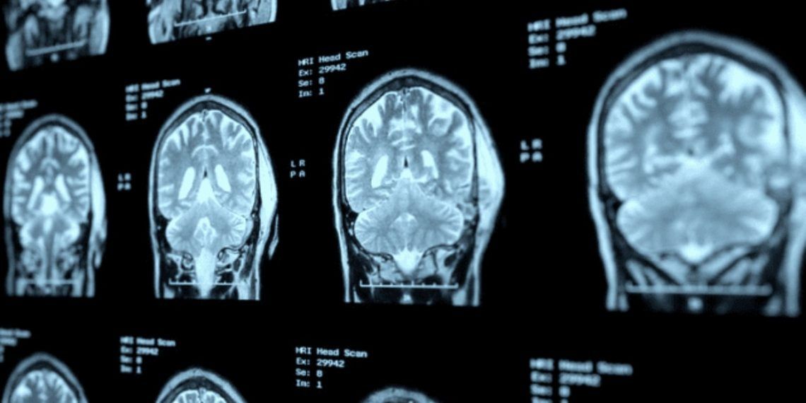 China: primer caso de Alzheimer en un joven de 19 años es detectado en Pekín