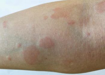 Lupus: Los riesgos asociados a esta enfermedad que puede afectar a casi cualquier tejido del cuerpo